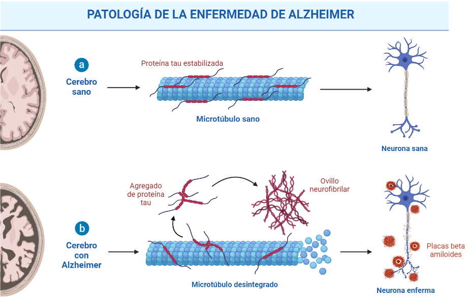 Figura 1. Comparación de un cerebro sano al de un paciente con Alzheimer 
Created with BioRender.com
